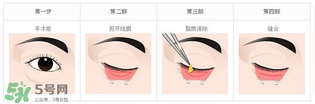 眼袋是怎么形成的？手術(shù)去眼袋安全嗎