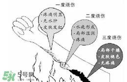 燙傷起泡要挑破嗎？燙傷起泡怎么處理？