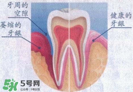 牙齦萎縮怎么辦？牙齦萎縮癥狀