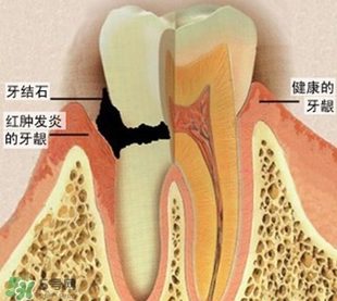 牙結(jié)石是什么？牙結(jié)石圖片