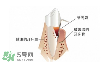 牙周炎怎么治療？牙周炎怎么治好