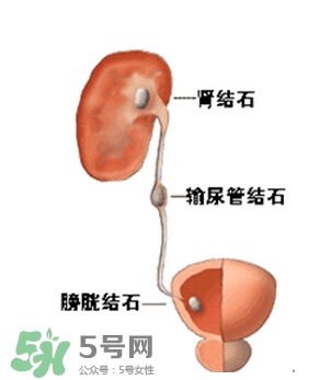 腎結(jié)石有什么癥狀？腎結(jié)石原因