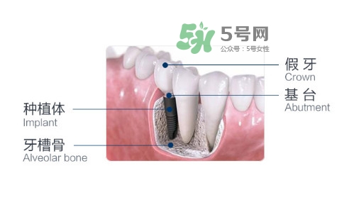 種植牙費(fèi)用多少錢？國產(chǎn)種植牙價格