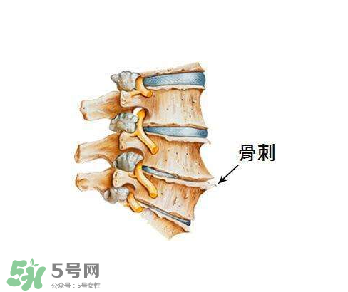 骨刺是怎么形成的？骨刺怎么治療？