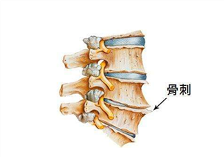 骨刺是怎么形成的？骨刺怎么治療？