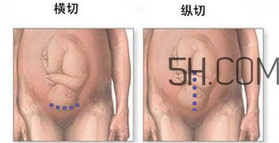 什么情況下需要剖腹產(chǎn) 剖腹產(chǎn)最全科普