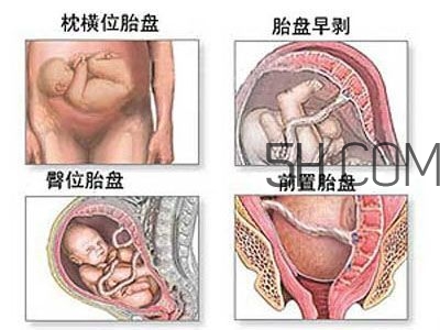 什么情況下需要剖腹產(chǎn) 剖腹產(chǎn)最全科普