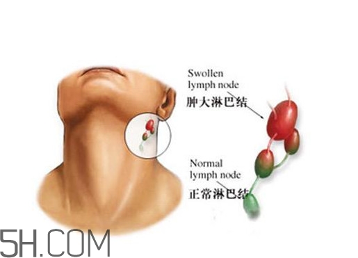 淋巴癌能活多久？淋巴癌癥狀有哪些