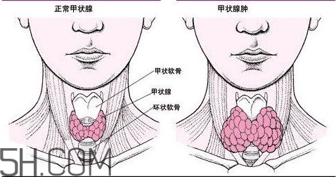 甲狀腺結(jié)節(jié)與甲狀腺腫瘤的區(qū)別有哪些？甲狀腺結(jié)節(jié)可以艾灸嗎