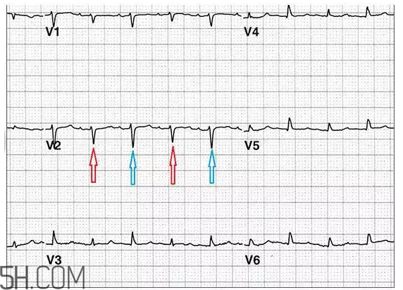 心電圖怎么看？6種常見心電圖異常情況