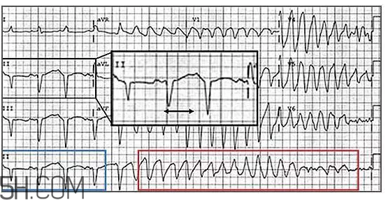心電圖怎么看？6種常見心電圖異常情況