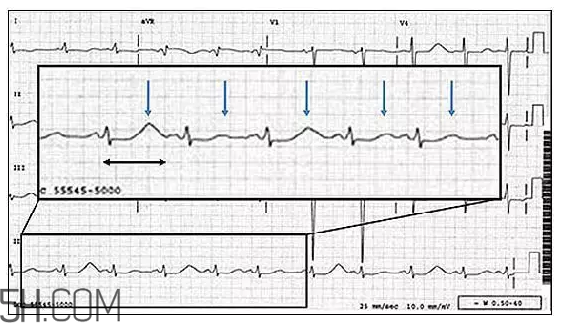 心電圖怎么看？6種常見心電圖異常情況