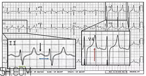 心電圖怎么看？6種常見心電圖異常情況