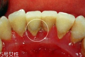 牙結(jié)石能自動脫落嗎？除了洗牙別無他法