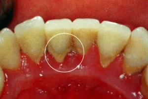 牙結(jié)石能自動脫落嗎？除了洗牙別無他法