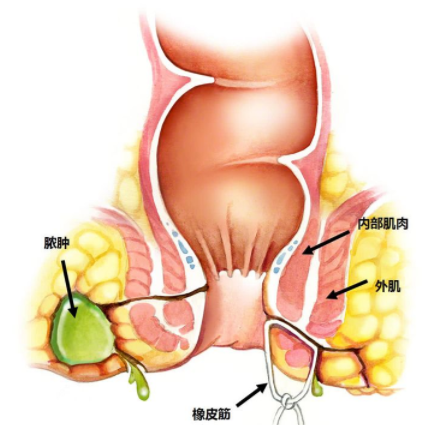 肛瘺非手術(shù)治療才可以嗎？手術(shù)是治療的關(guān)鍵途徑