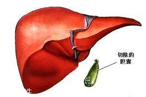 膽囊為什么容易長結石？與個體因素密切相關