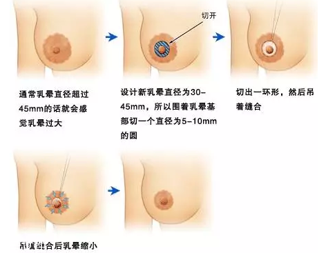 乳暈縮小術(shù)怎么做？乳暈縮小術(shù)知識全解