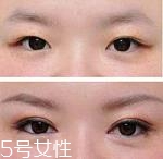 開(kāi)眼角疤痕多久消失？開(kāi)眼角的適宜人群