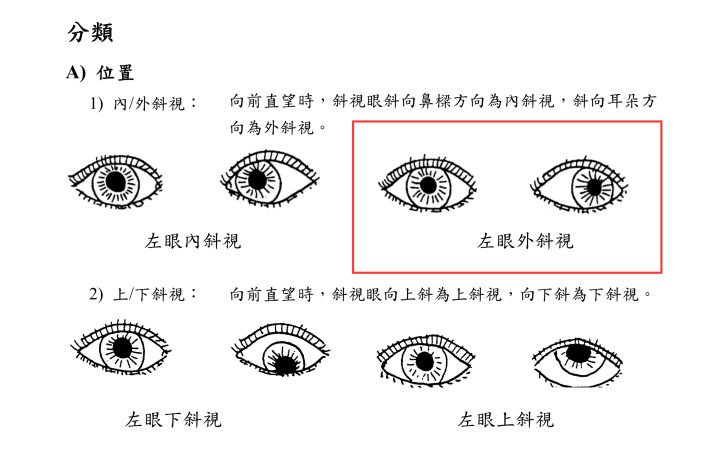 斜視是什么意思 斜視帶來(lái)生活的影響