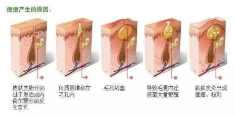 頑固痘痘怎么消除？油皮為什么反復爆痘？