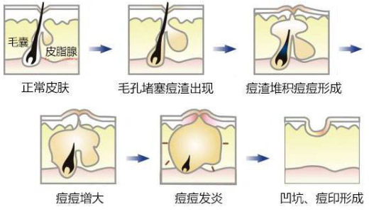 油性皮膚怎么去痘印最快 煩人痘印只需三步走