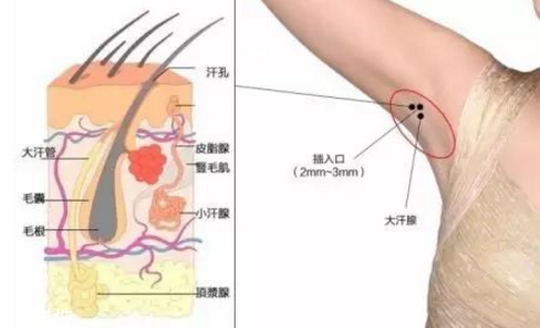 肉毒素有什么作用 打肉毒素的作用