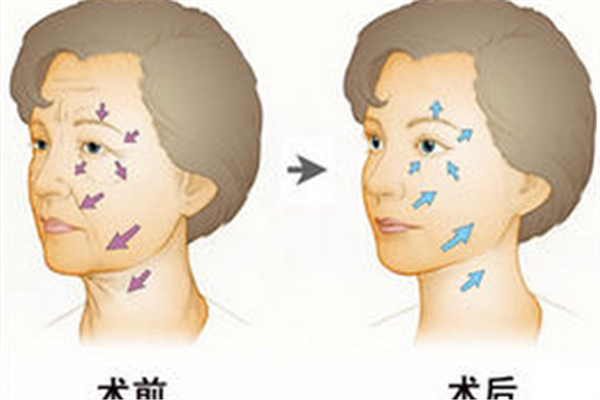 打除皺針的最佳時(shí)間是什么 什么時(shí)候打除皺針好