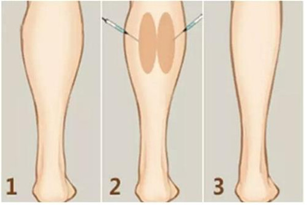 瘦腿針要打幾次 瘦腿針最少需要打幾次