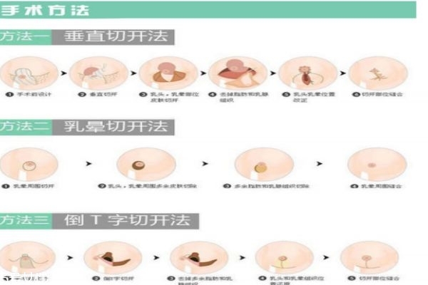 縮胸手術(shù)是什么 為什么要做縮胸手術(shù)