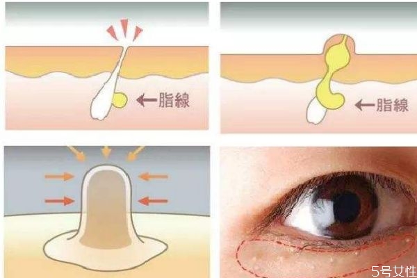 脂肪粒是怎么形成的呢 脂肪?？梢宰约汉脝?></p><h3>脂肪?？梢宰约汉脝?/h3><p>很多人都有長脂肪粒的煩惱，但是卻并不是所有長脂肪粒的人都知道要怎么去去除它們，還有很多女生覺得，脂肪粒長了就長了，沒必要去搭理它們，過段時(shí)間之后皮膚就會(huì)自動(dòng)的把它們的消滅了。雖說，我們每一個(gè)人的皮膚確實(shí)有自我修復(fù)的作用，有一部分脂肪粒也確實(shí)可以在一定的時(shí)間內(nèi)被我們自身的調(diào)節(jié)機(jī)制去除，但是大部分人長的脂肪粒，并不會(huì)在時(shí)光里被治愈，而是在漫長的歲月里，一直停留在你臉上，為你的形象減分。</p><p style=