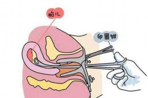 宮外孕試紙能測(cè)出來(lái)嗎 宮外孕hcg值的范圍