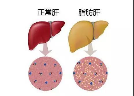 騎自行車對(duì)脂肪肝有用嗎 騎自行車對(duì)頸椎病有幫助嗎