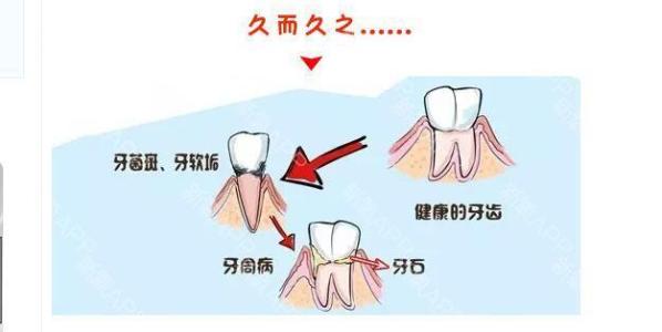 洗牙有哪些壞處呢 洗牙有哪些危害呢