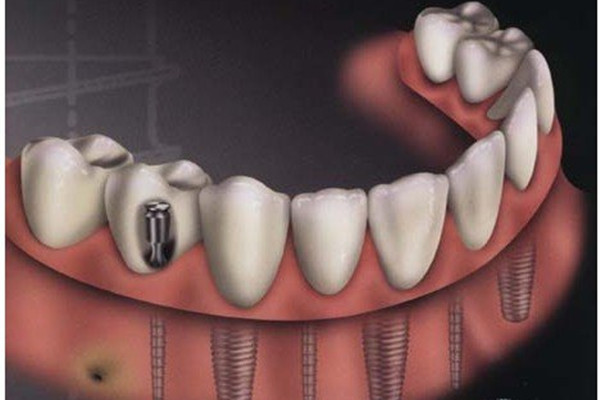 種植牙齒的危害 種植牙齒的副作用