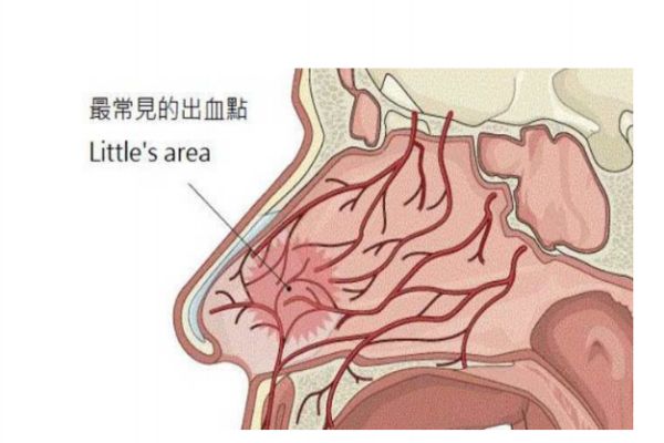 經(jīng)常流鼻血是怎么回事 經(jīng)常流鼻血怎么辦