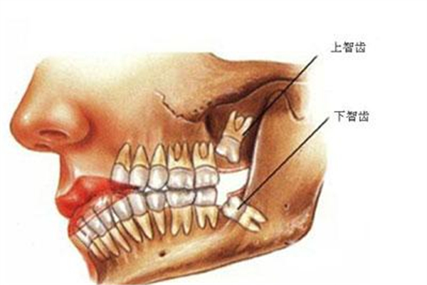 智齒有必要拔嗎 智齒不拔有什么危害