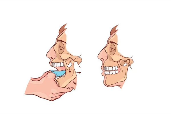 下巴脫臼怎么回事 下巴脫臼掛哪個科