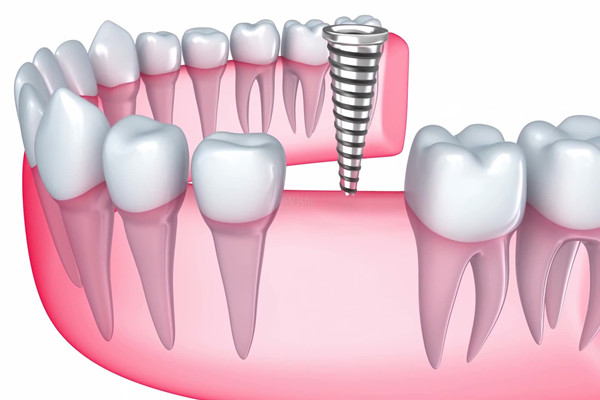 種植牙如何護理 種植牙會有后遺癥嗎