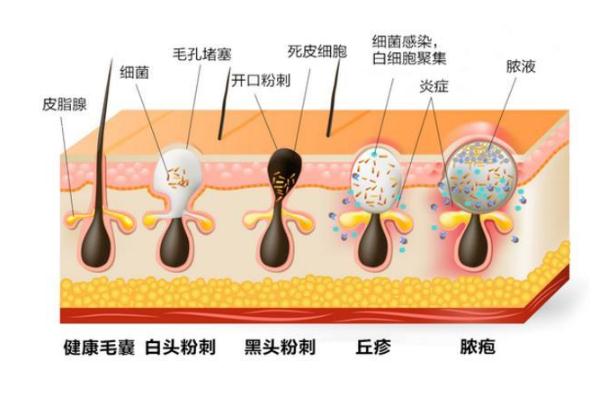 粉刺要不要擠出來(lái) 粉刺要怎么處理