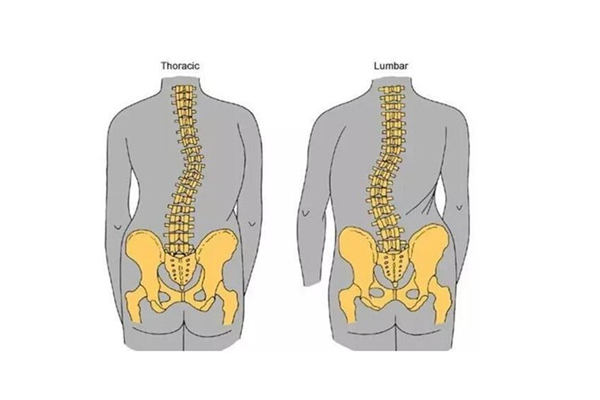骨盆前傾可以通過正骨恢復嗎 骨盆前傾去哪里矯正