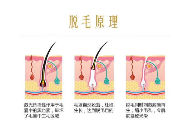 激光脫毛有燒焦的味道 脫毛儀為什么會(huì)有燒焦味