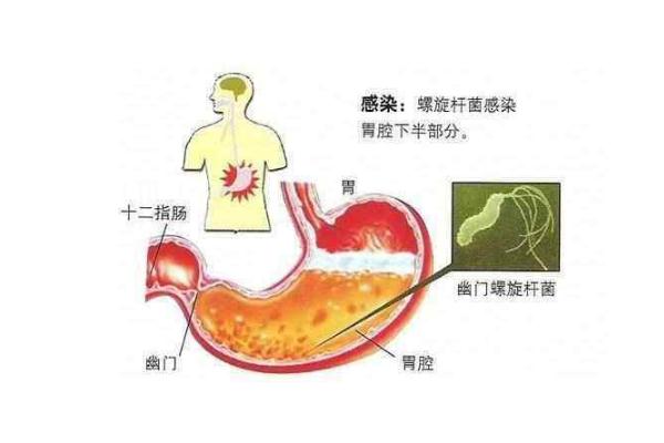 幽門螺桿菌要空腹查嗎 幽門螺桿菌要注意什么