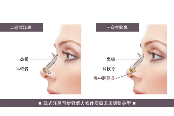 耳軟骨隆鼻可以維持多久 耳軟骨隆鼻需要多少錢(qián)