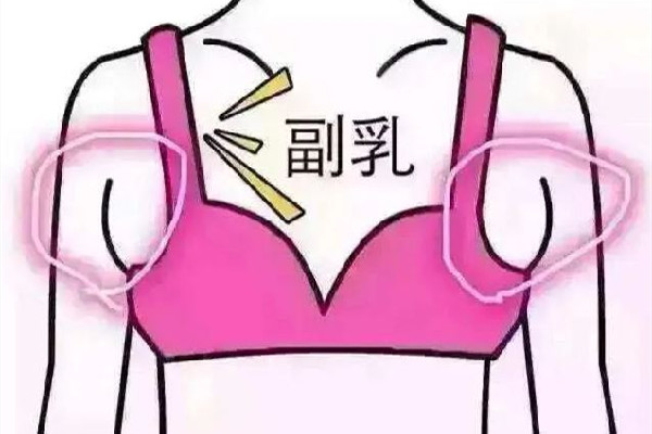 副乳切除手術會有疤痕嗎 副乳切除手術怎么才能看不到疤痕